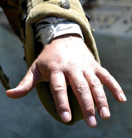 Shannon's spider bite